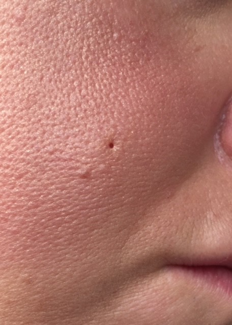 Deep Ice Pick Scar With Pics Scar Treatments Forum