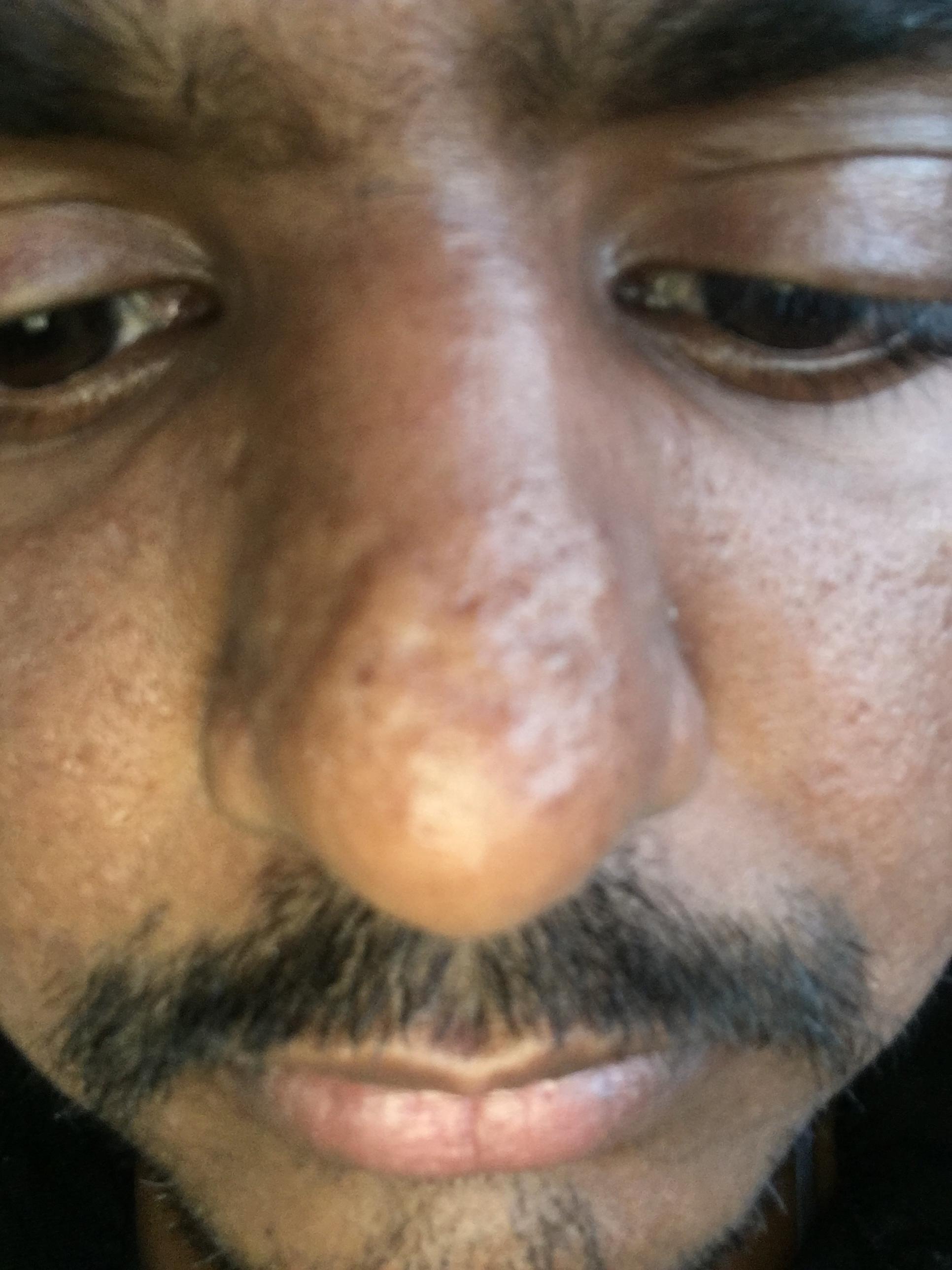 Bumps on my nose - General acne discussion - by Playboy99 ...