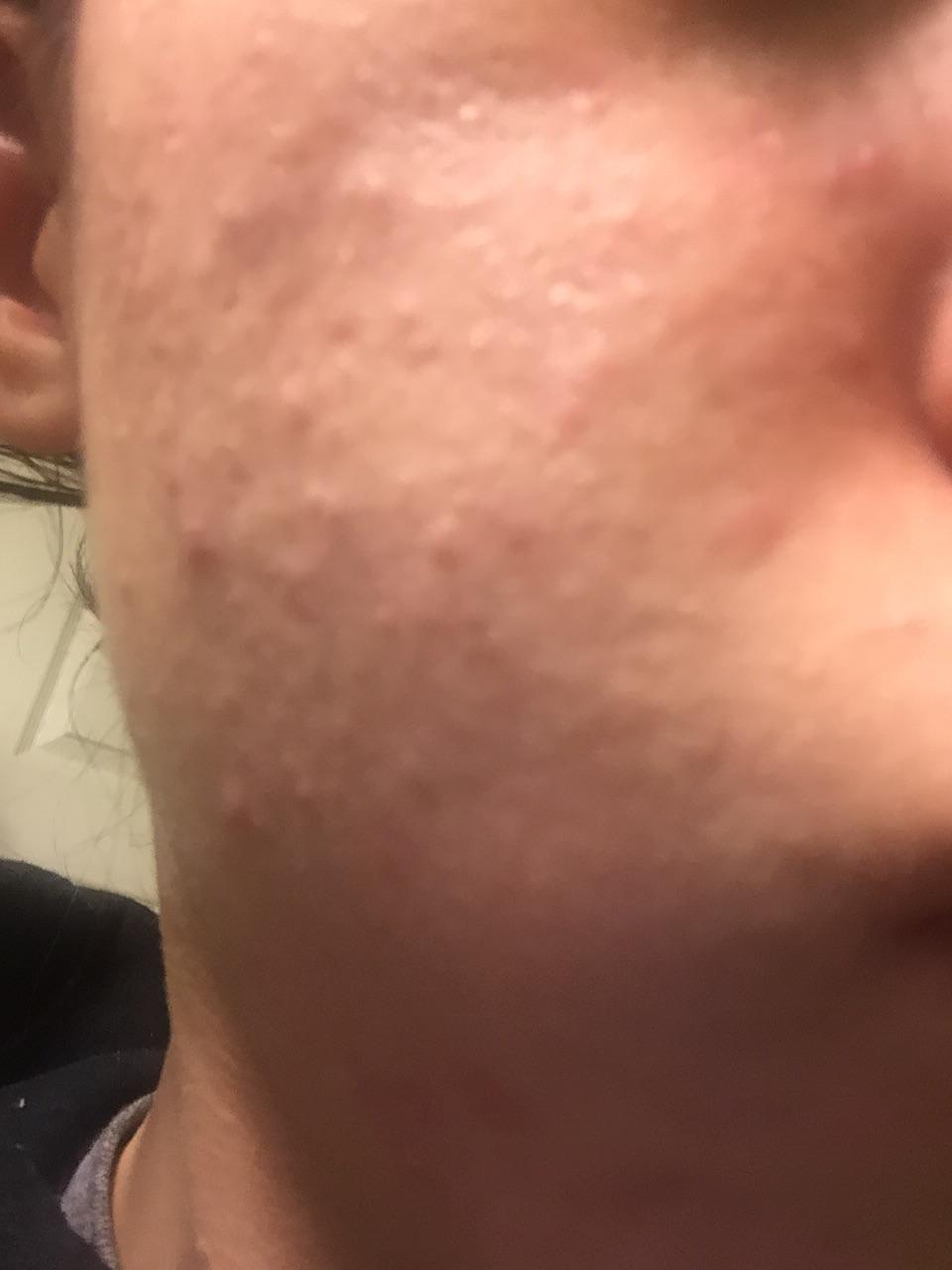 Clogged pores?? Help - General acne discussion - by WiredCanteen - Acne