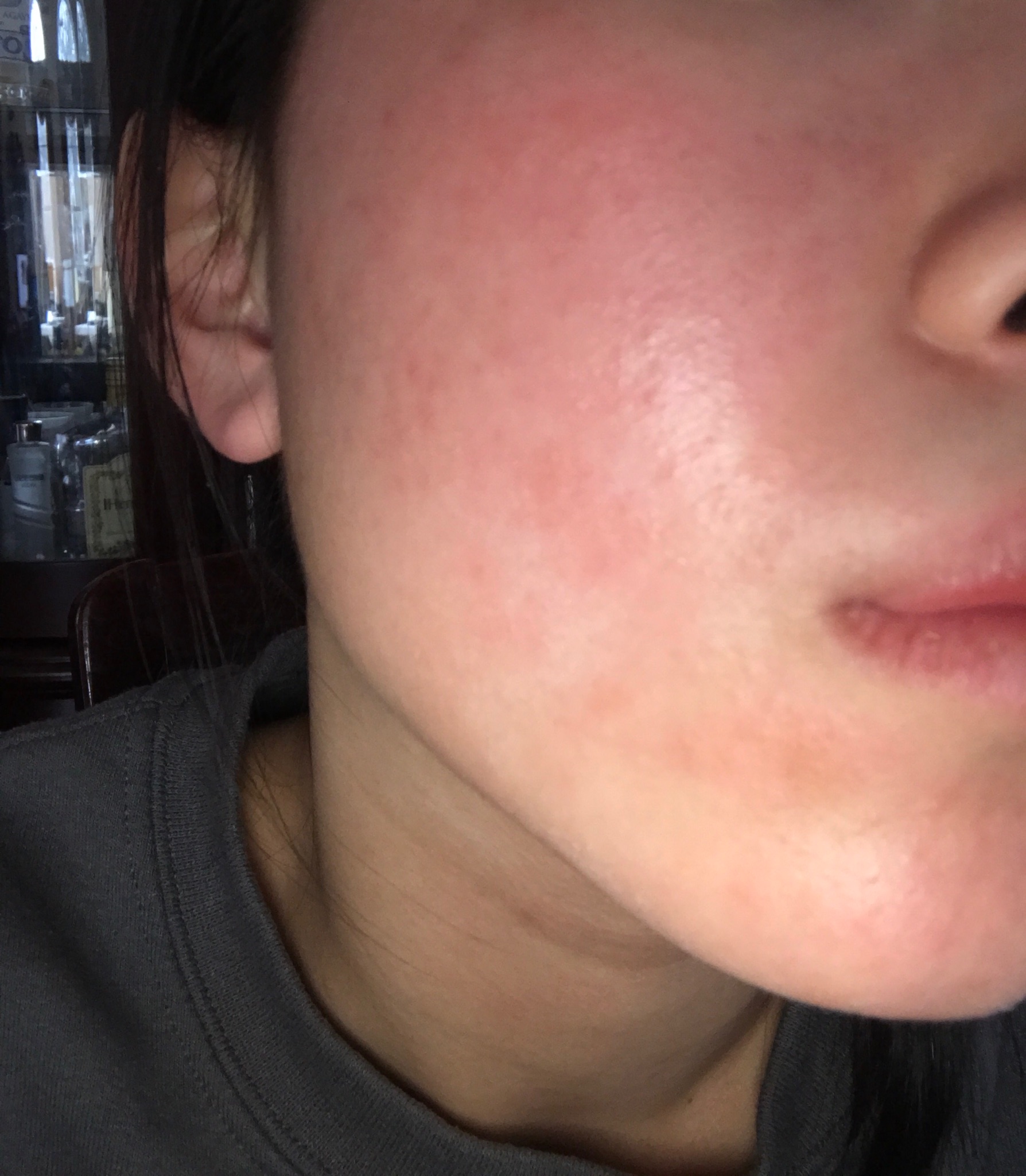 Small bumps rash-like itchy skin- Folliculitis? Staph infection? – General  acne discussion –  Forum