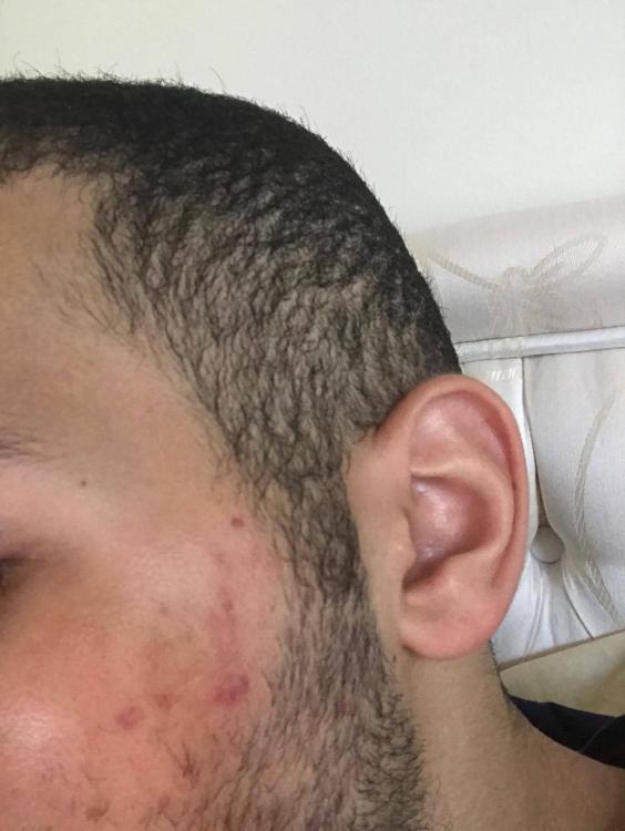 scar after 2.jpg
