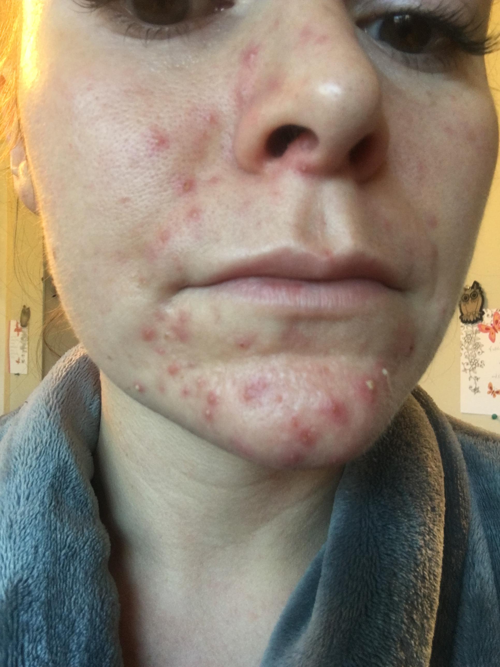 Cystic acne on chin 9 months after stopping Yasmin ...