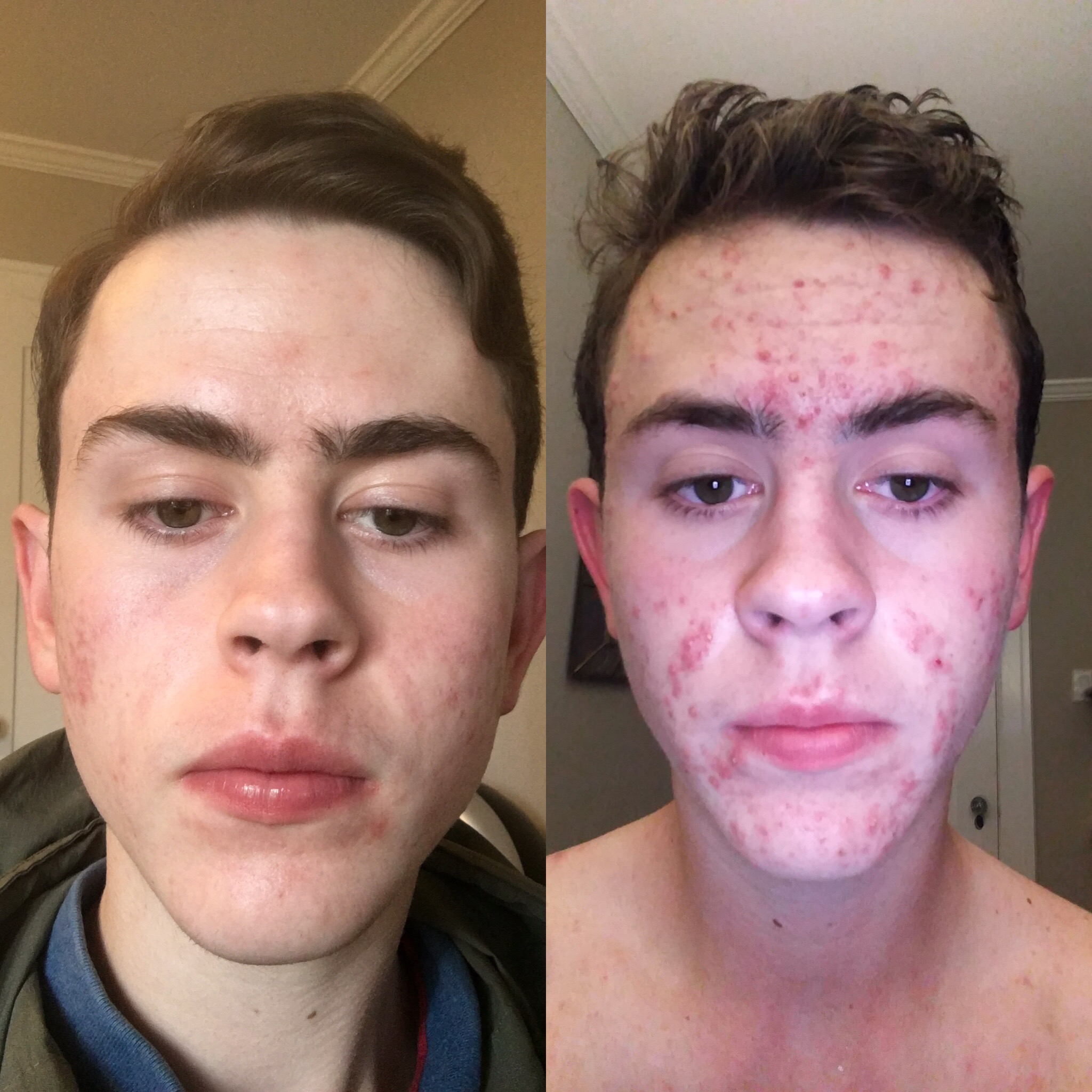The day before I started Isotretinoin vs. 5 months in. Truly magic. (20mg/ day, 50 kg, Sotret) : r/Accutane