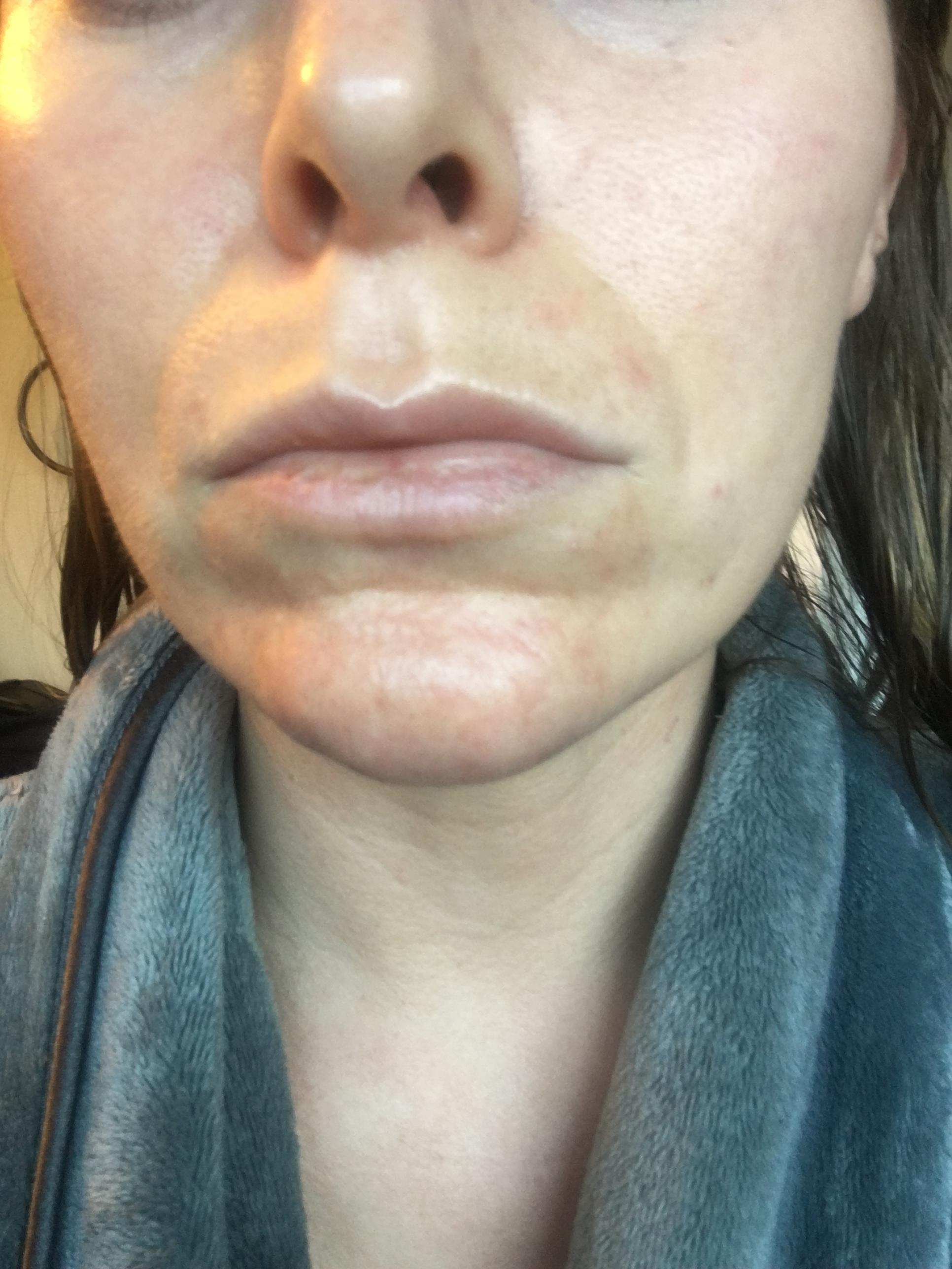 Cystic Acne On Chin 9 Months After Stopping Yasmin General Acne 0058