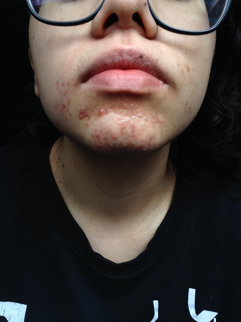 My 5+ month battle with my face. - General acne discussion ...