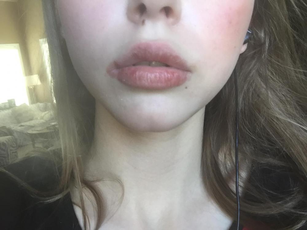 Extremely Bad Dry And Split Lips On Accutane Accutane Isotretinoin 
