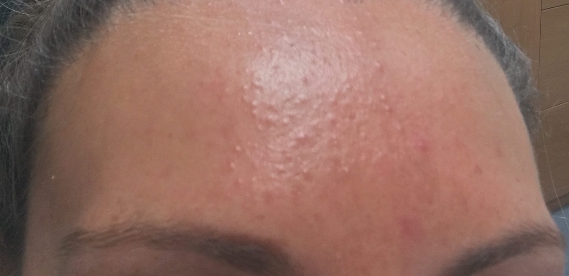 Small Colourless Bumps On My Forehead General Acne Discussion