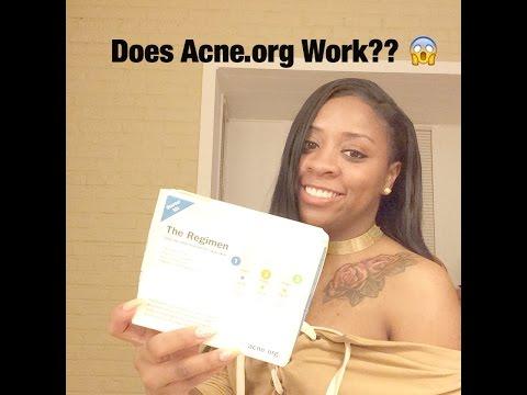 5 months on Acne.org Regimen