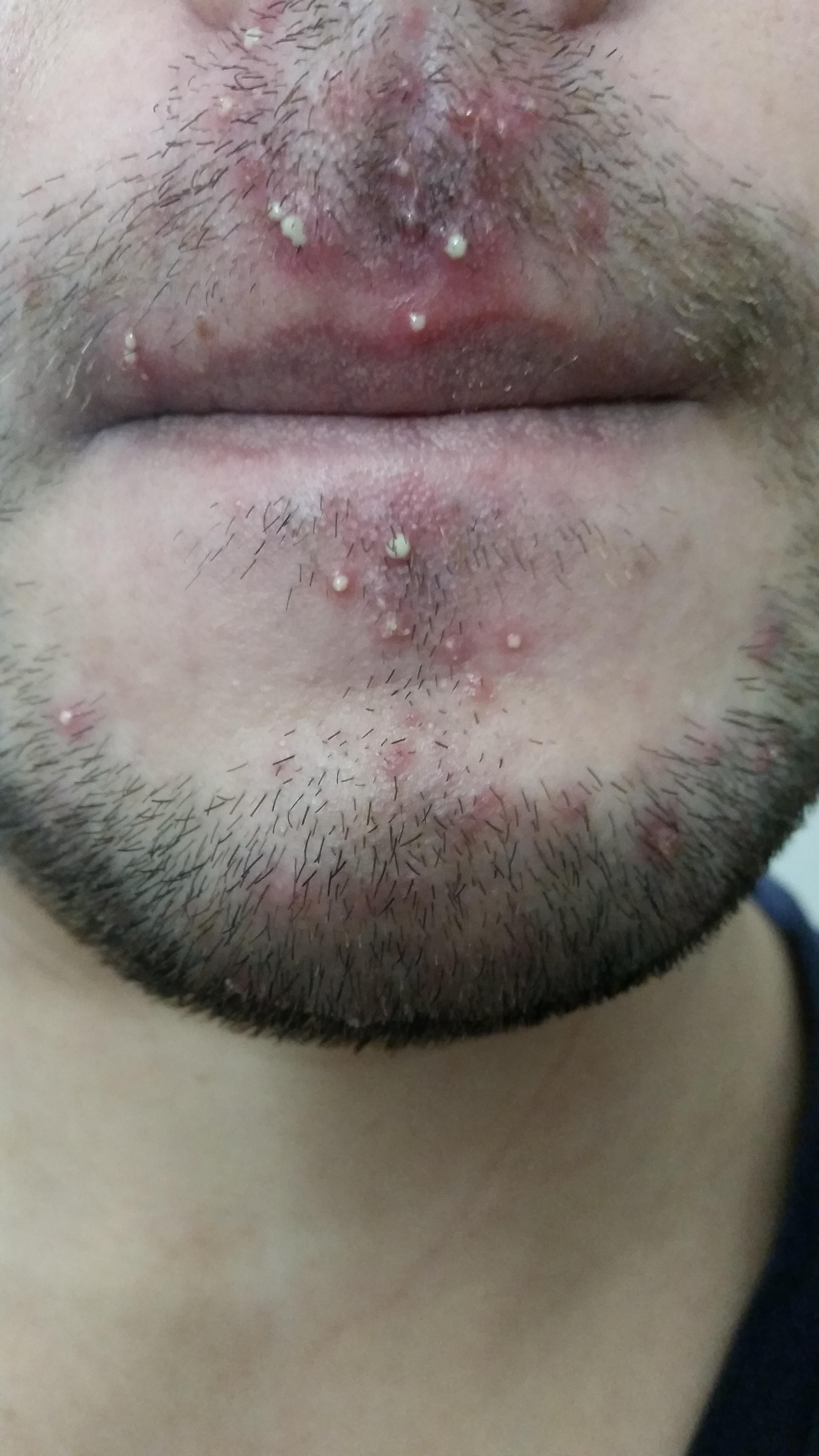 white pimple with puss