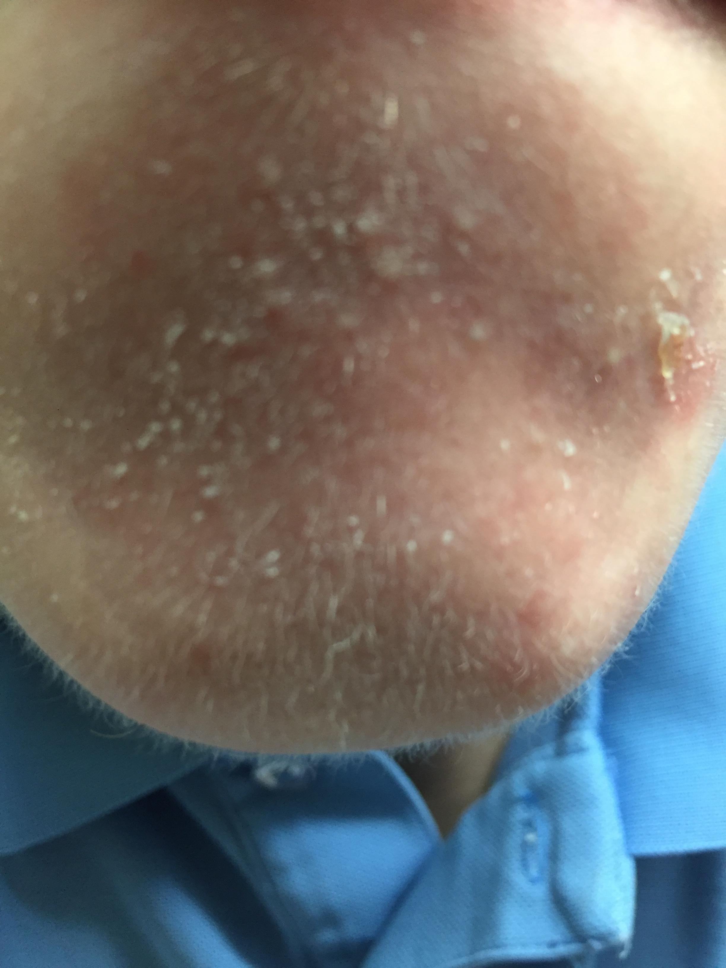 Little White Bumps That Turn Into Pimples General Acne Discussion Forum 