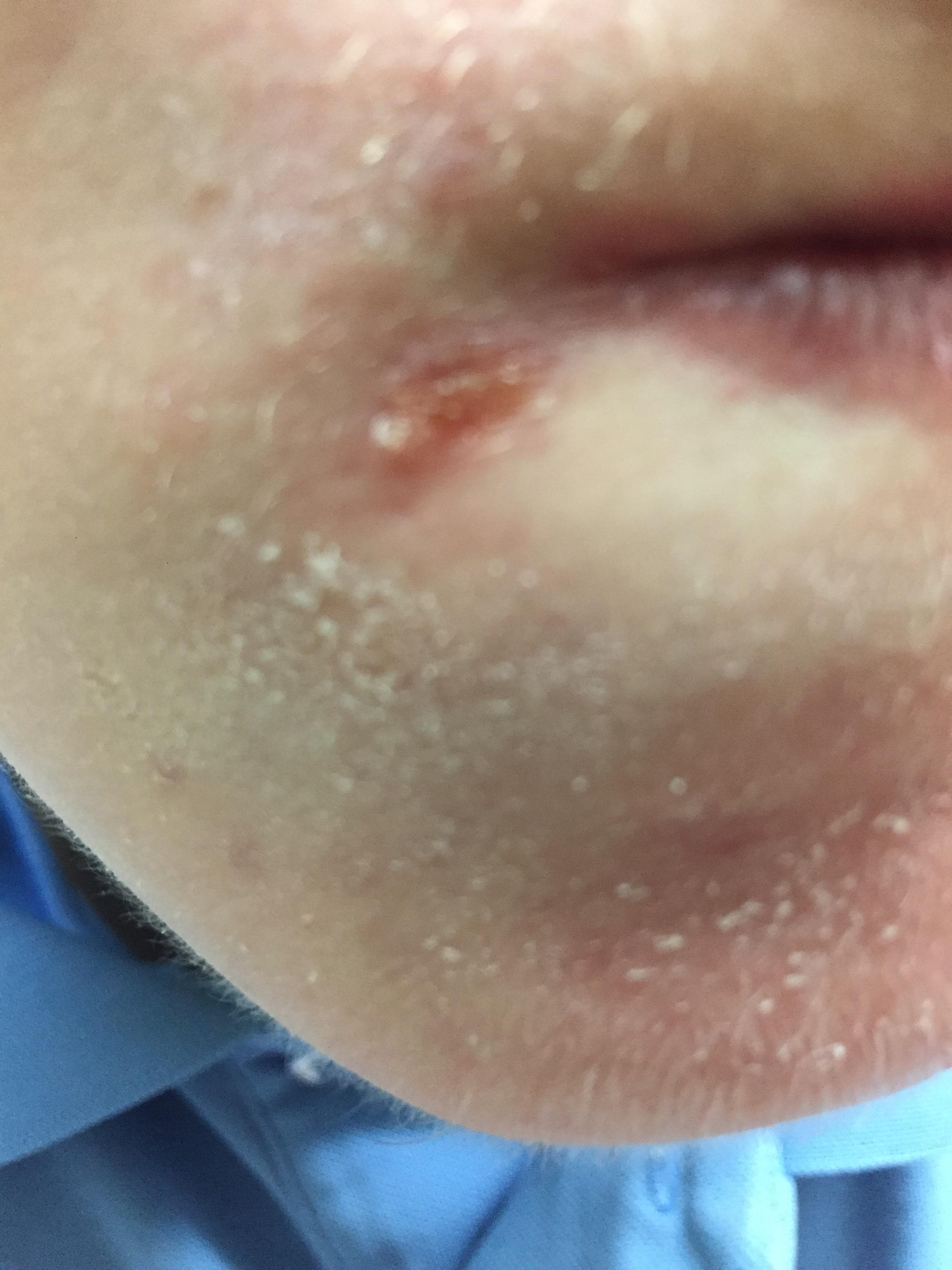 Little White Bumps That Turn Into Pimples General Acne Discussion