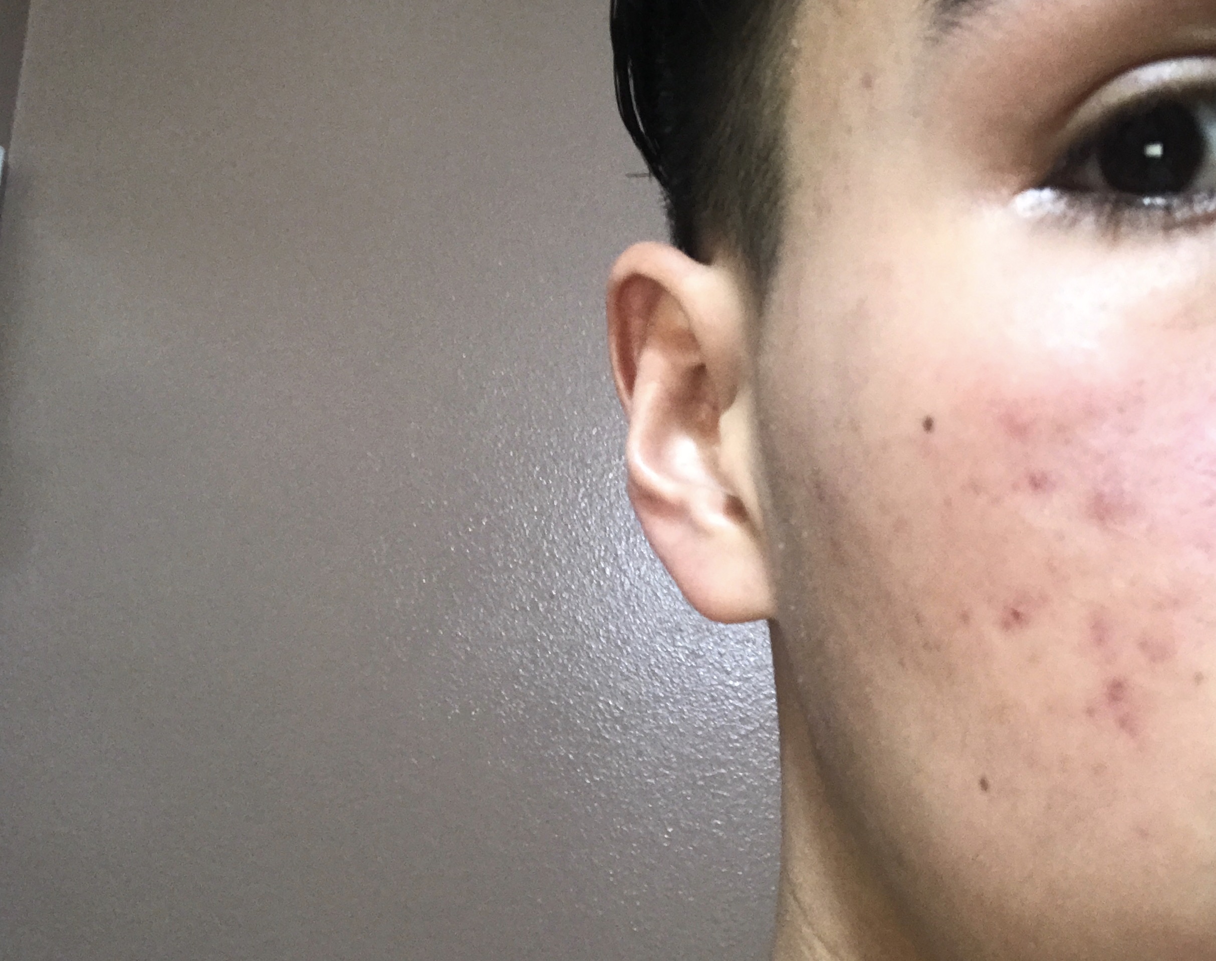 Acne Improvementwhat To Do About These Red Marks General Acne