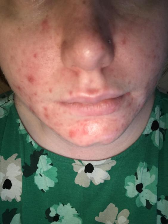 acne.jpg