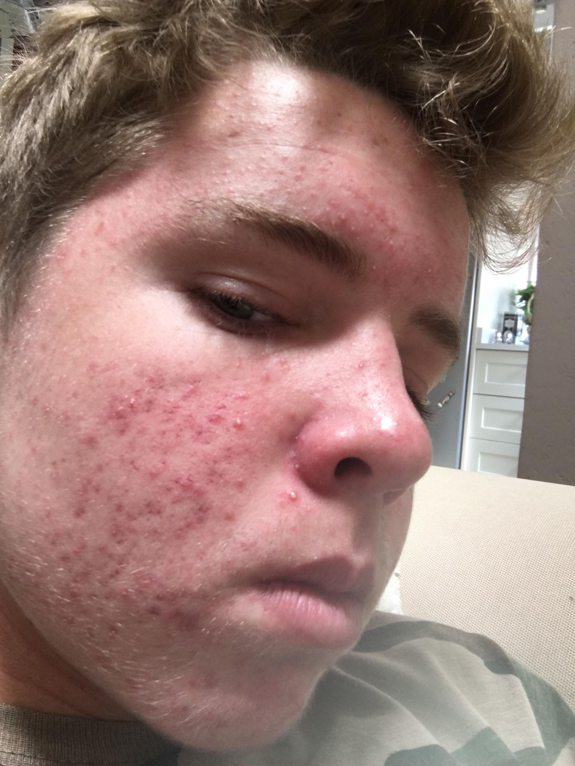 Acne After Accutane It works like a topical but stronger 