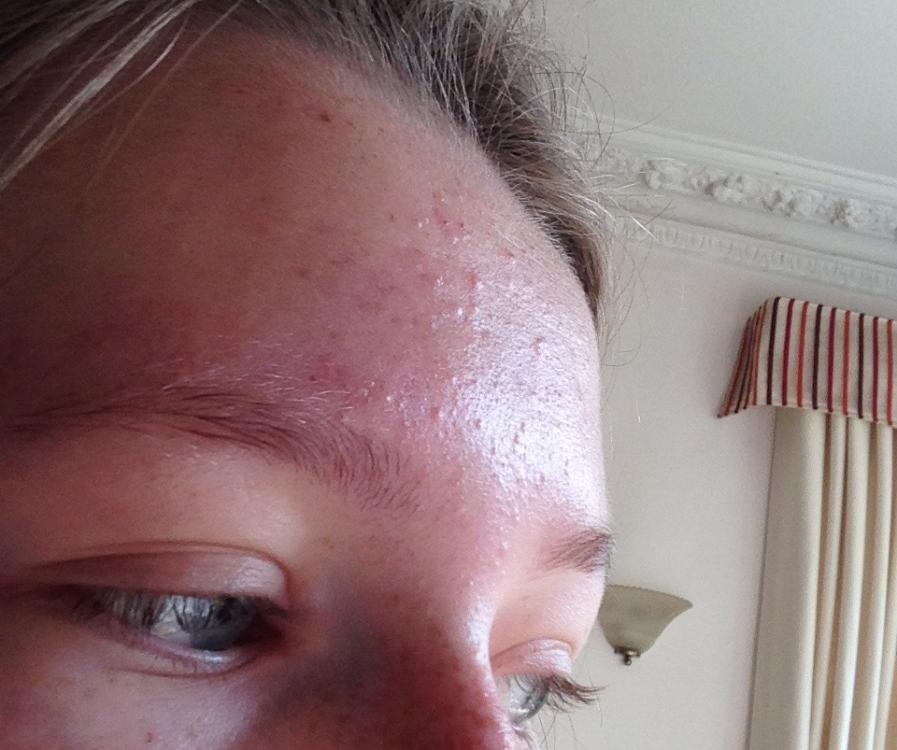 Mild to moderate forehead acne - General acne discussion - Acne.org