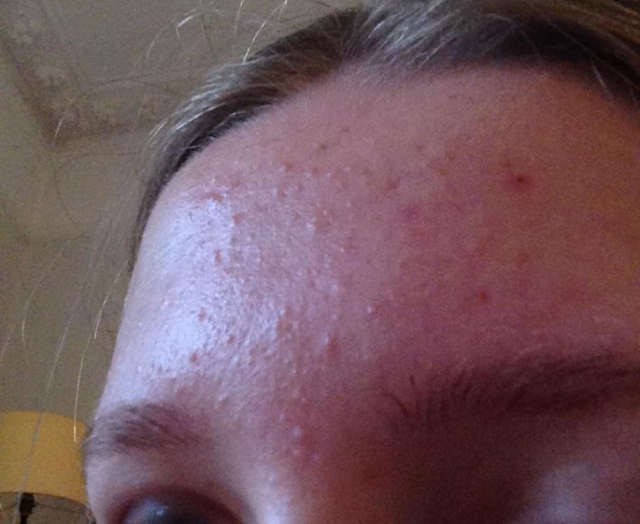 Mild to moderate forehead acne – General acne discussion – Acne.org Forum