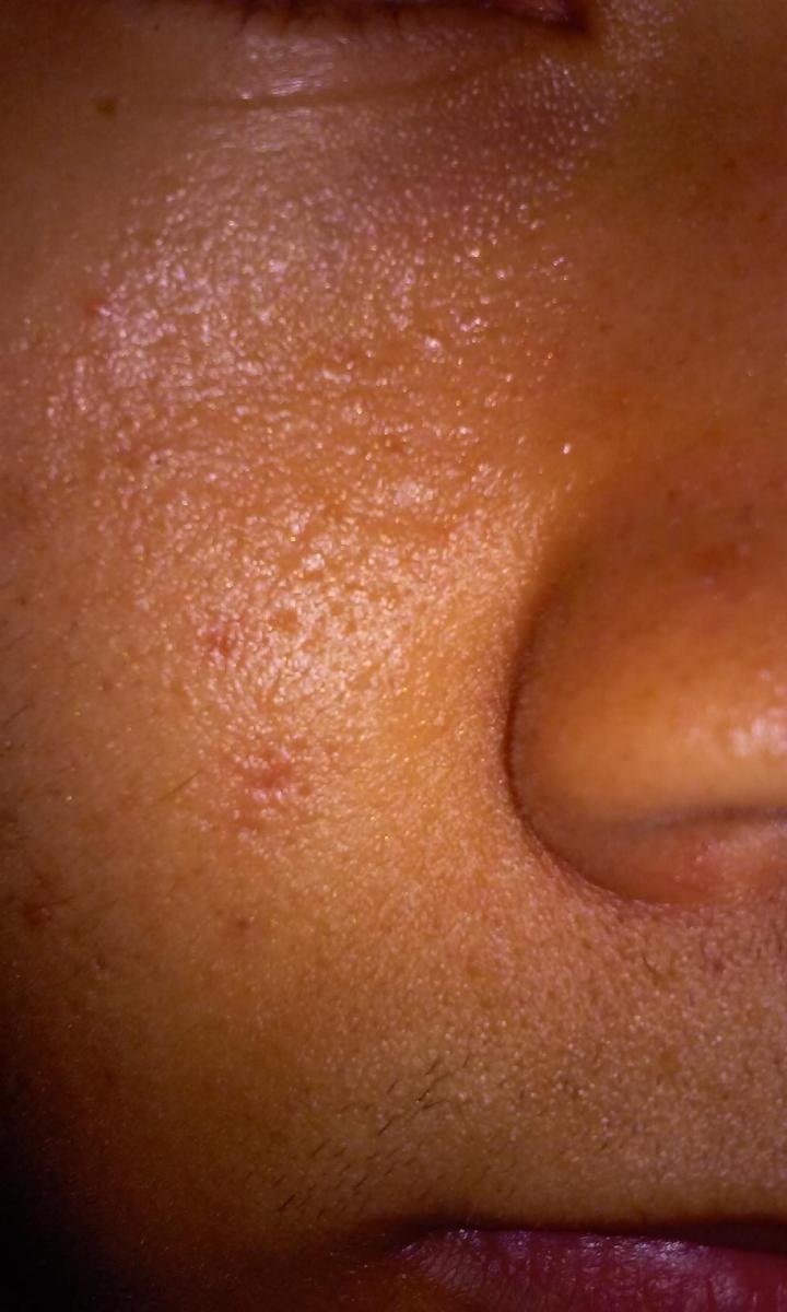scar skin texture