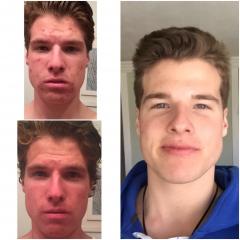 Results and after before accutane