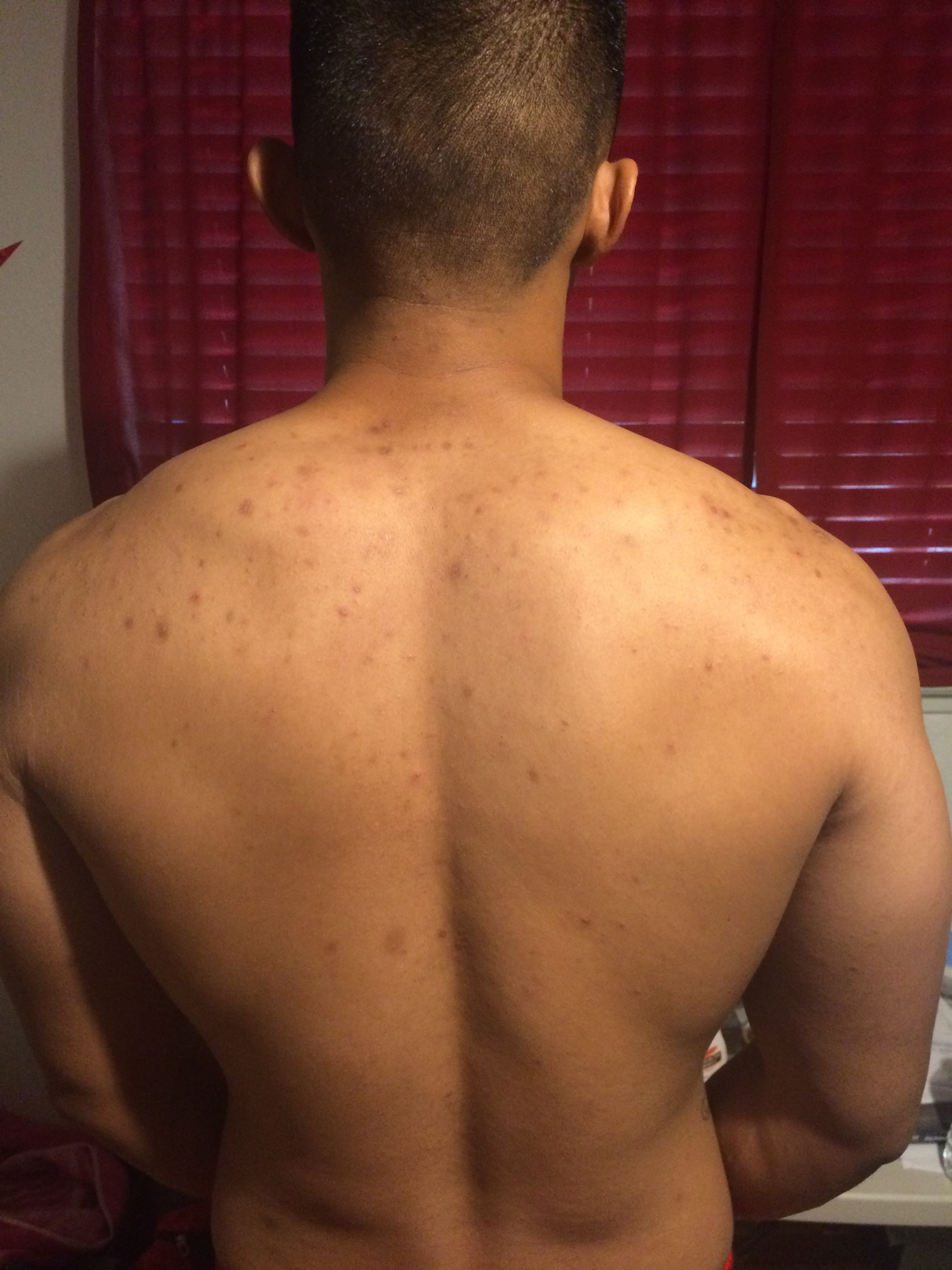 Back Acne Scars, Need Advice (With Photos) - Hyperpigmentation - red