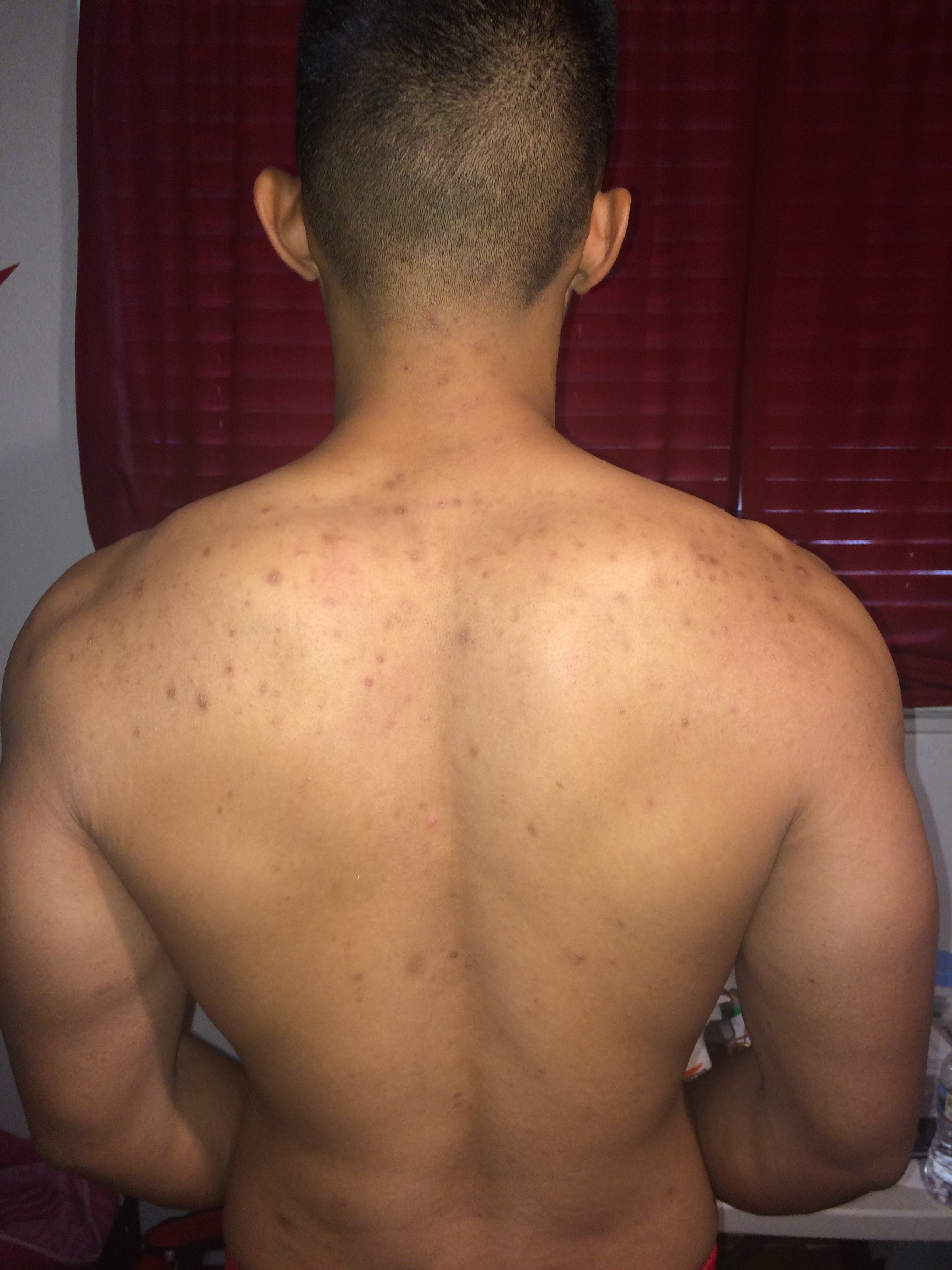 Back Acne Scars Need Advice With Photos Hyperpigmentation Red