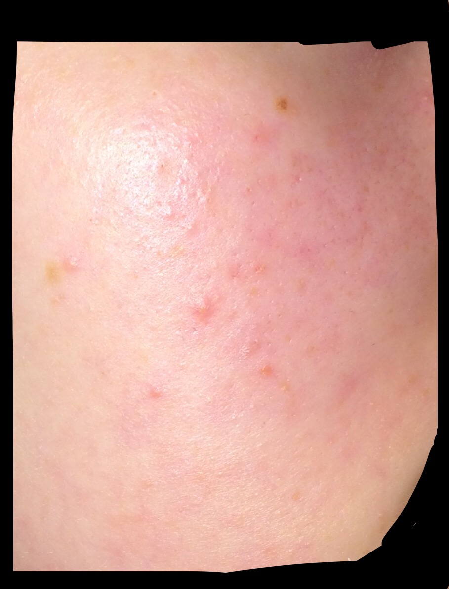 Tiny Bumps And Redness General Acne Discussion