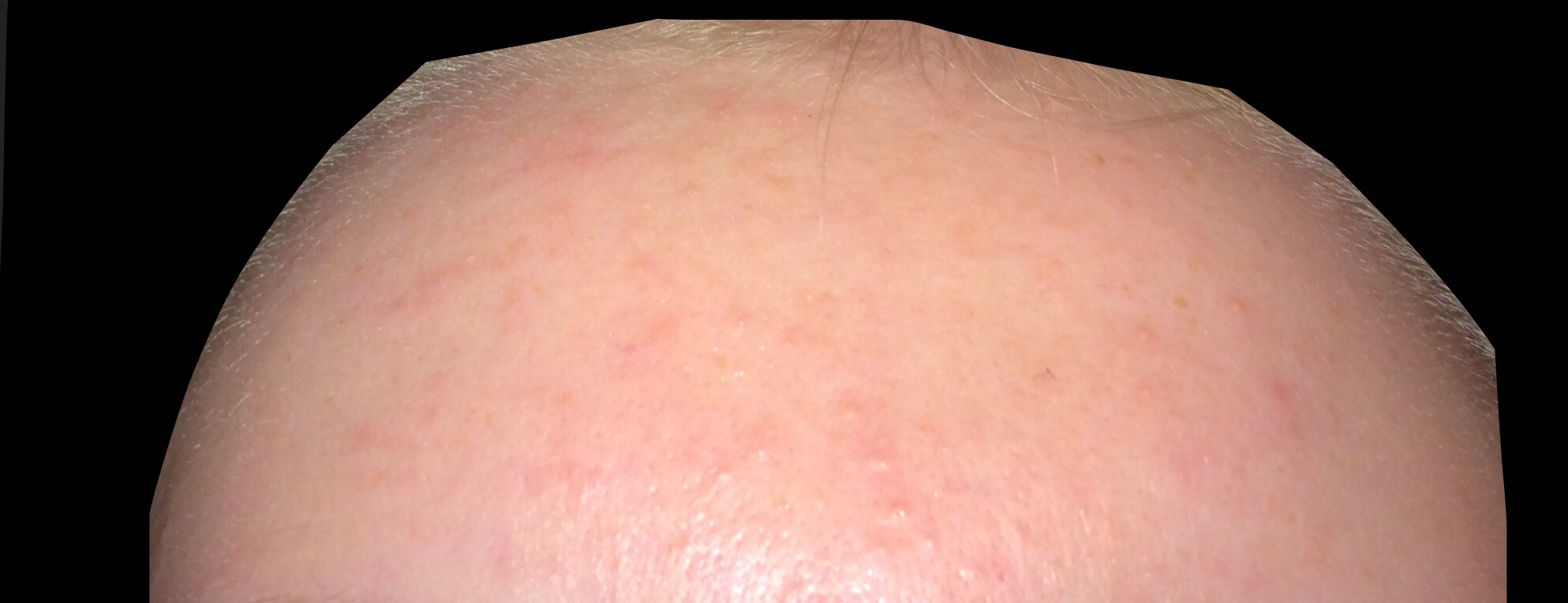 Tiny Bumps And Redness General Acne Discussion By Superanonymous