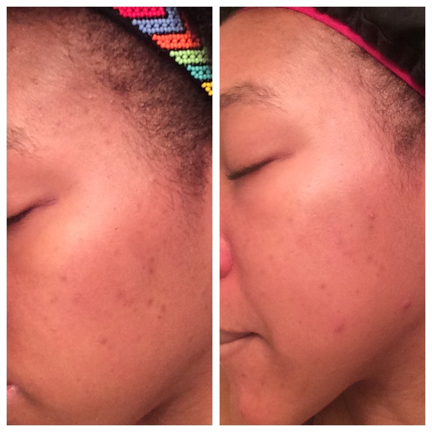 Fade Dark Spots Hyperpigmentation Fast Hyperpigmentation Reddark