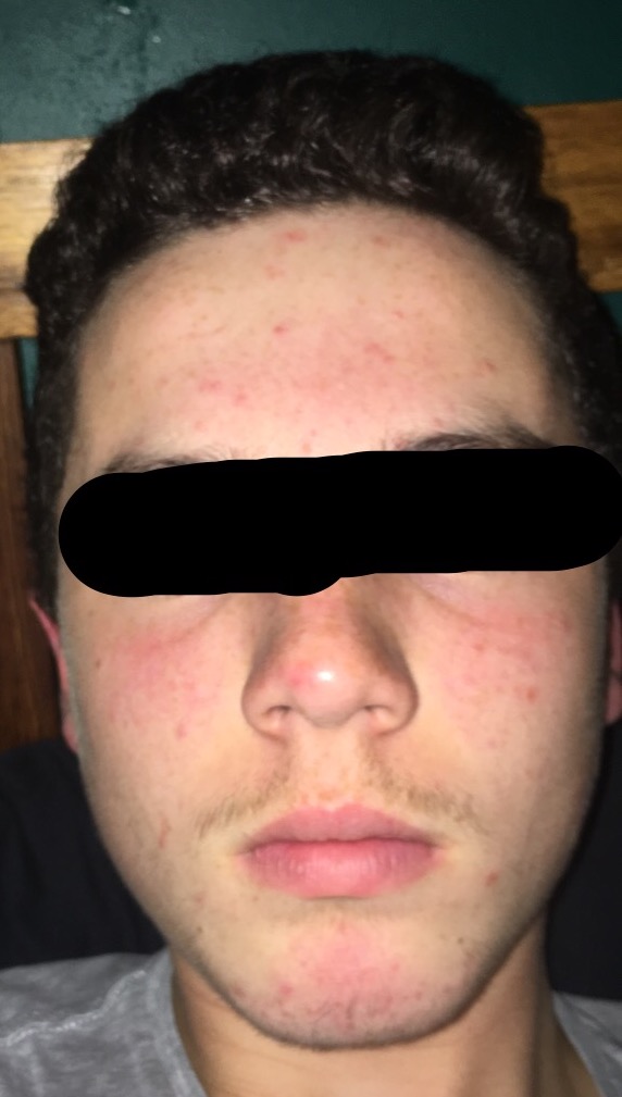 diagnosis-pleaseee-general-acne-discussion-acne-forum