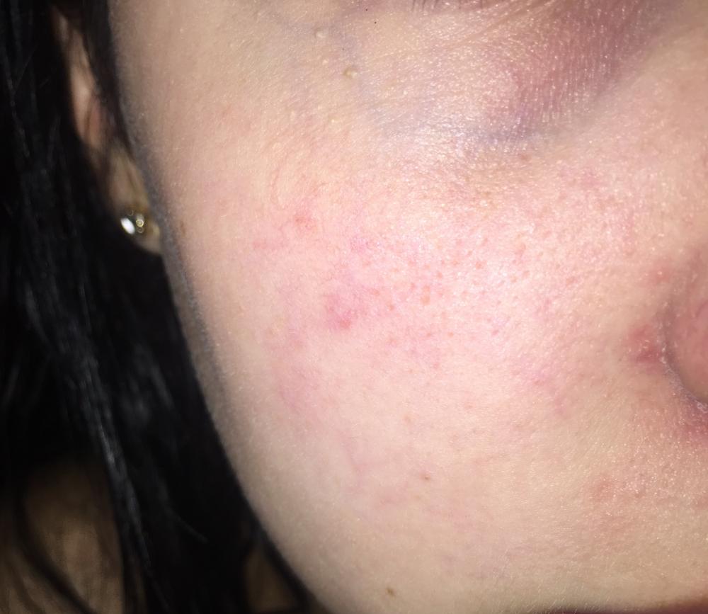 Rednessirritated Appearance On Face Rosacea And Facial Redness By