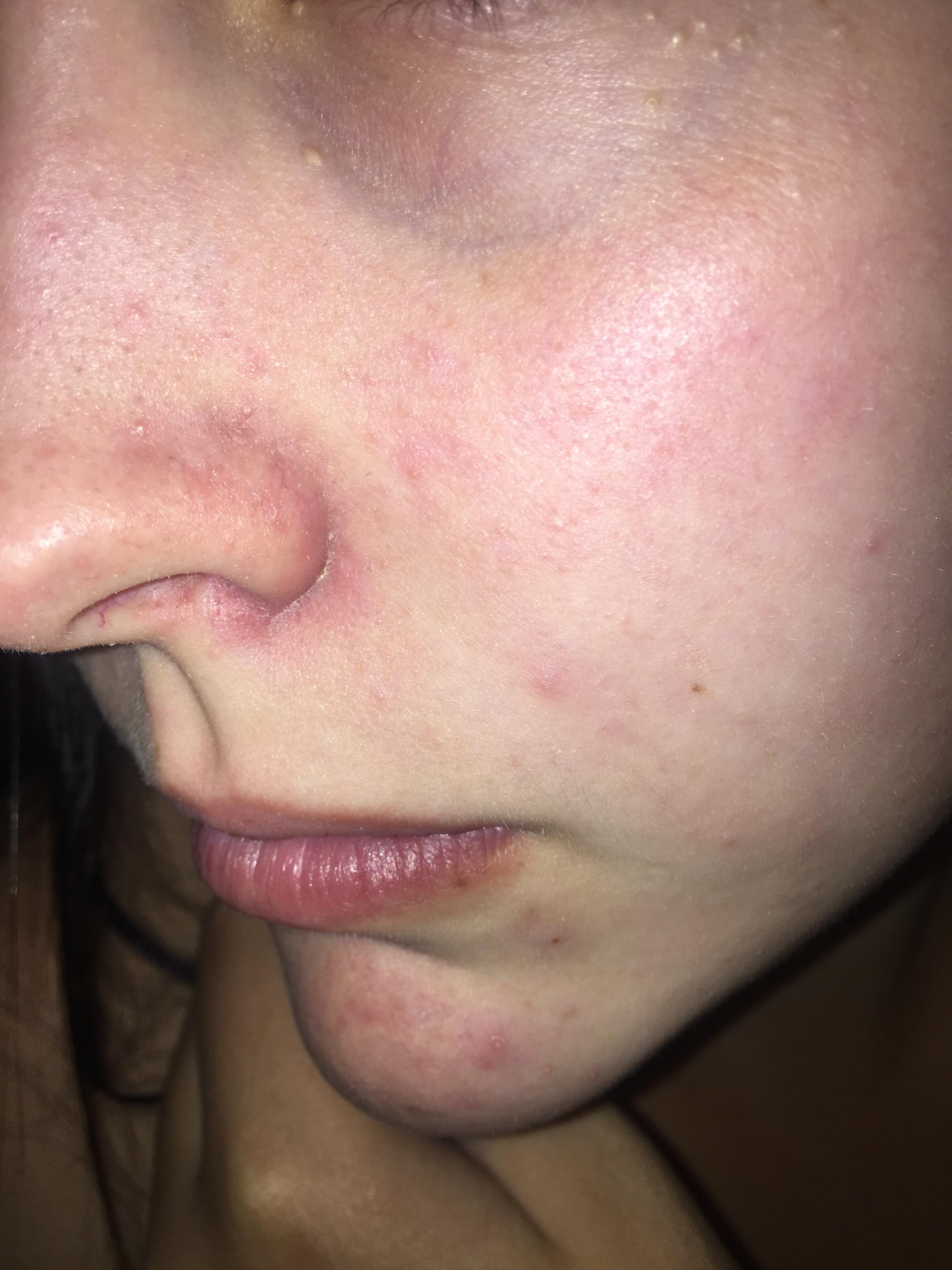 Redness Irritated Appearance On Face Rosacea And Facial Redness By