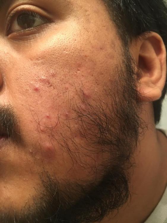 acne.jpg