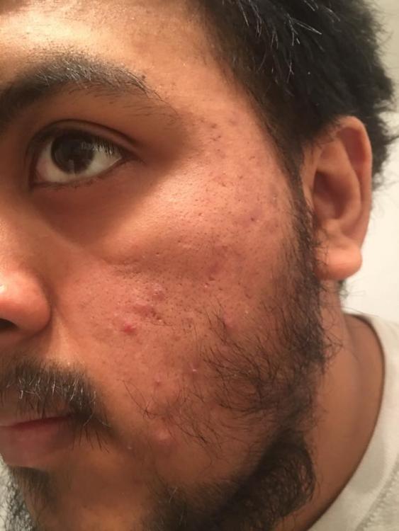 acne1.jpg