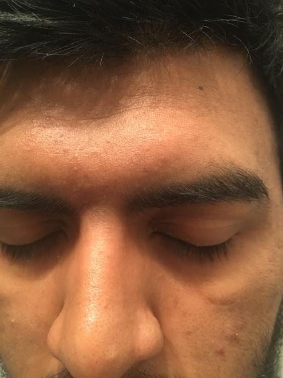 acne2.jpg
