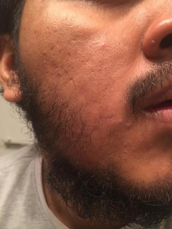 acne3.jpg