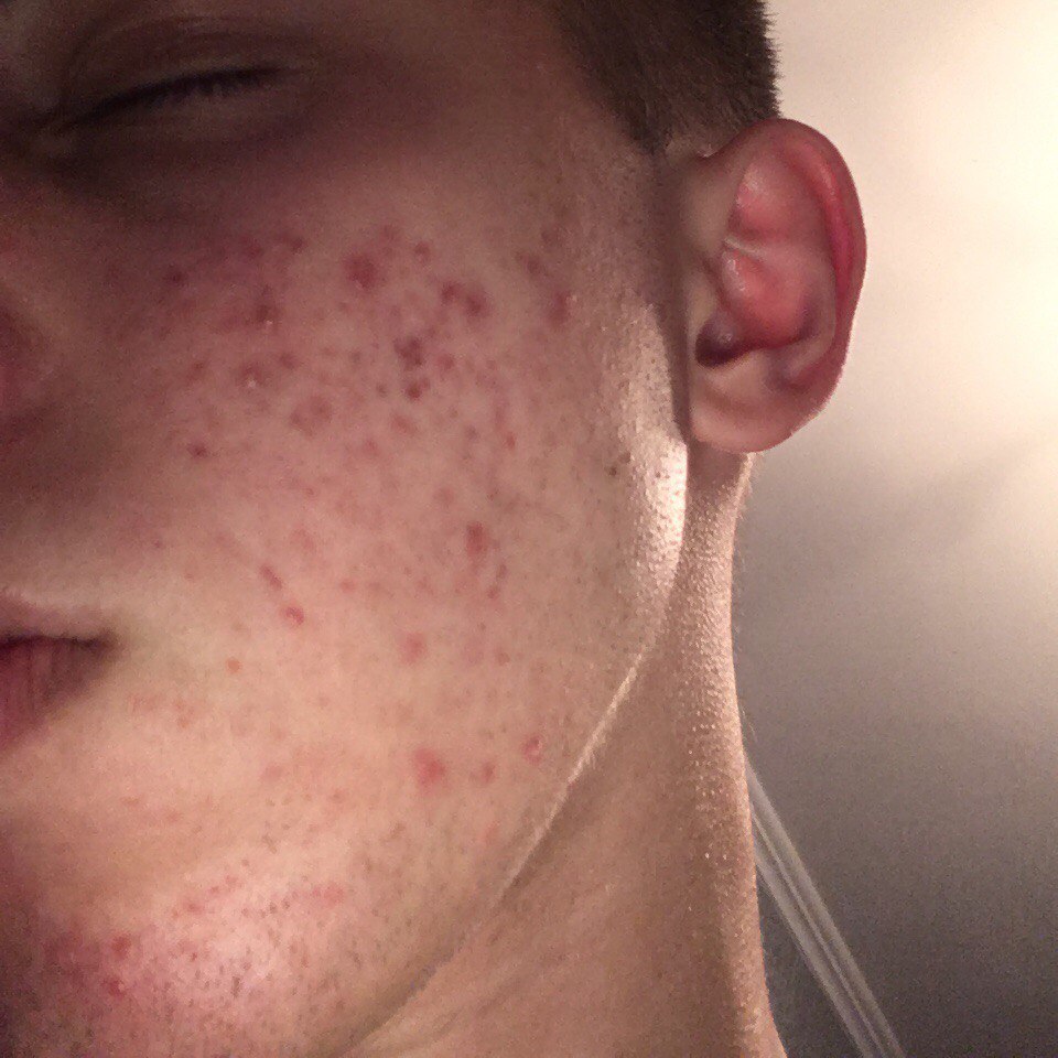 Red marks how to get rid? (pics) Hyperpigmentation