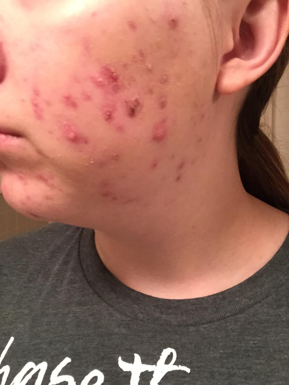 Active acne+scabs won't heal HELP (photos included - Adult acne - by
