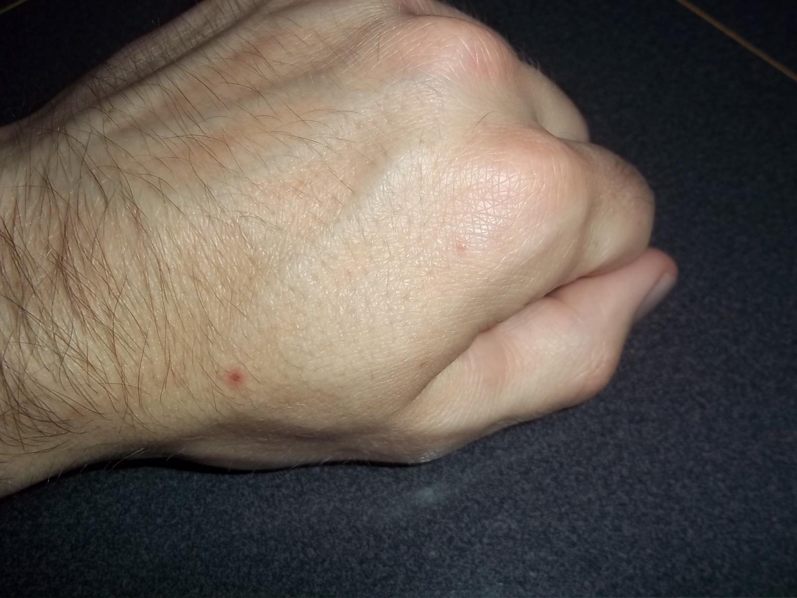 Pimple On The Hand Causes And Treatment Vrogue