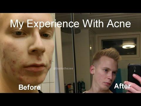 How I Cured My Acne
