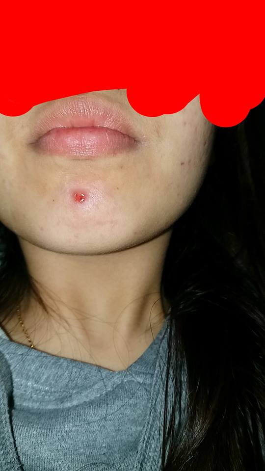 popped pimple