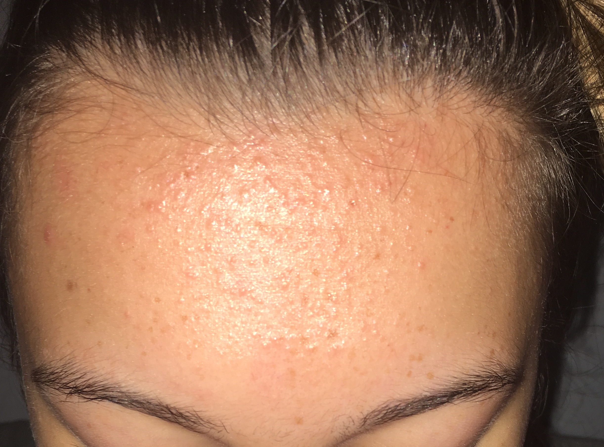 Tiny Bumps On Forehead Treatment How To Get Rid Of Ti Vrogue co