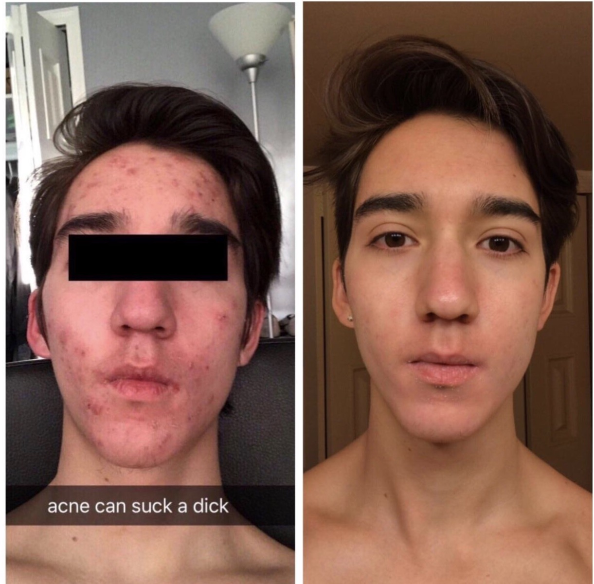 After accutane month 1 and before