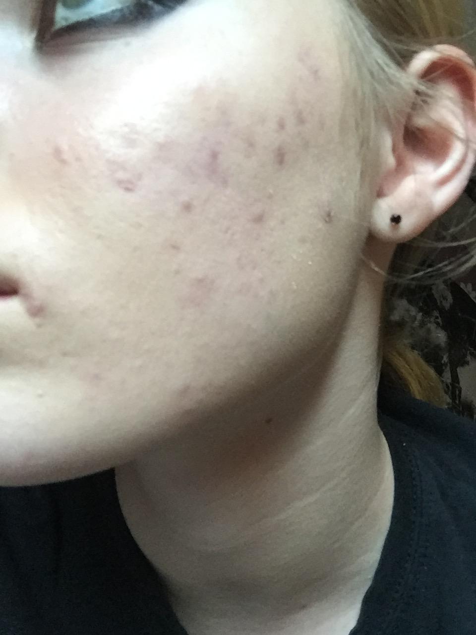 How do I heal these red acne scars?? - Hyperpigmentation ...