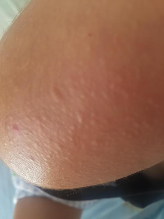 Lailamoon's 'Tiny bumps on my shoulders , white under skin' - Pictures