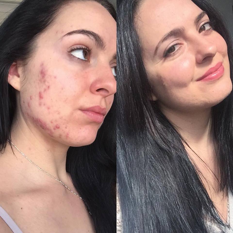 How I Cleared My Acne Naturally