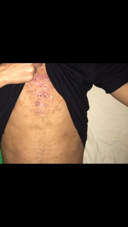 acne 1.jpg