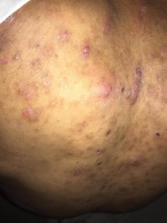 acne 2.jpg