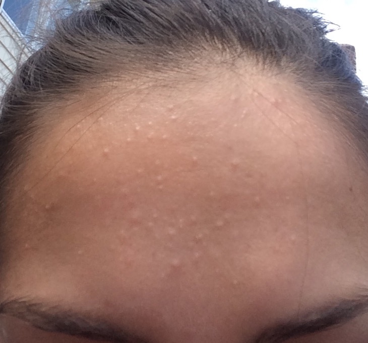 small-bumps-on-forehead-general-acne-discussion-by-a1842l-acne