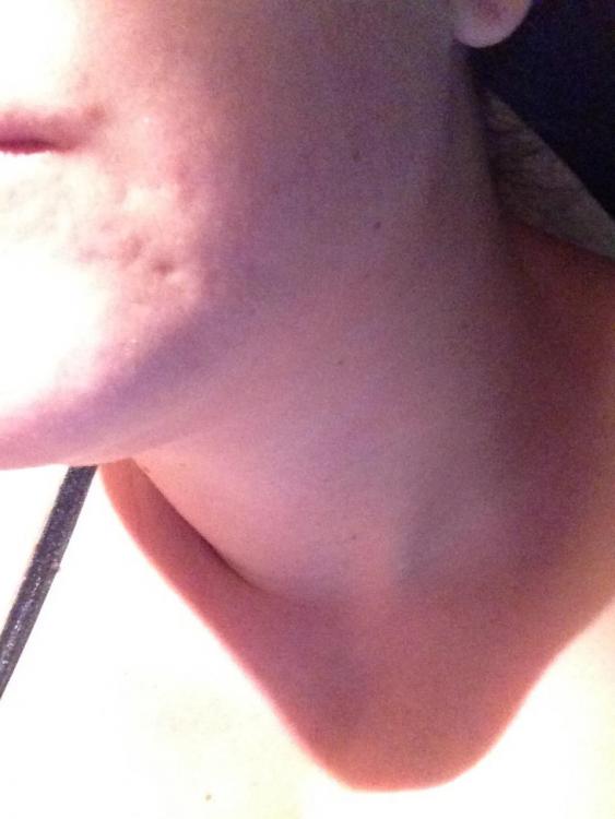 scars3 (2).JPG