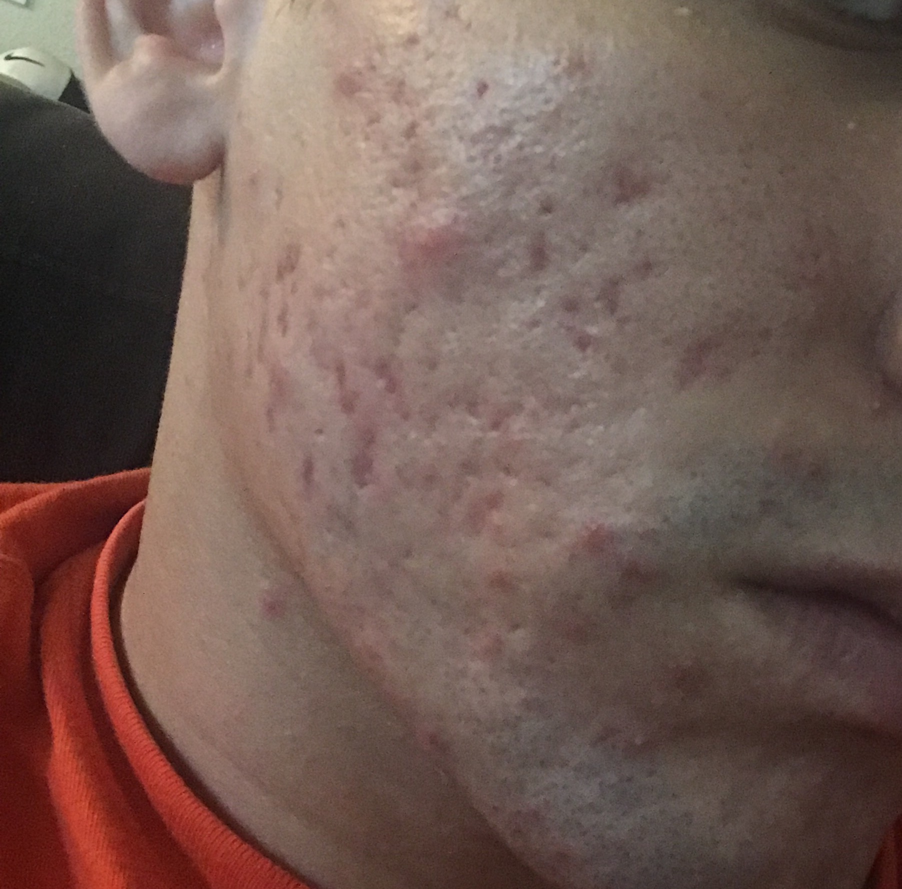 Need help with acne/scars ! - Scar treatments - Acne.org Community