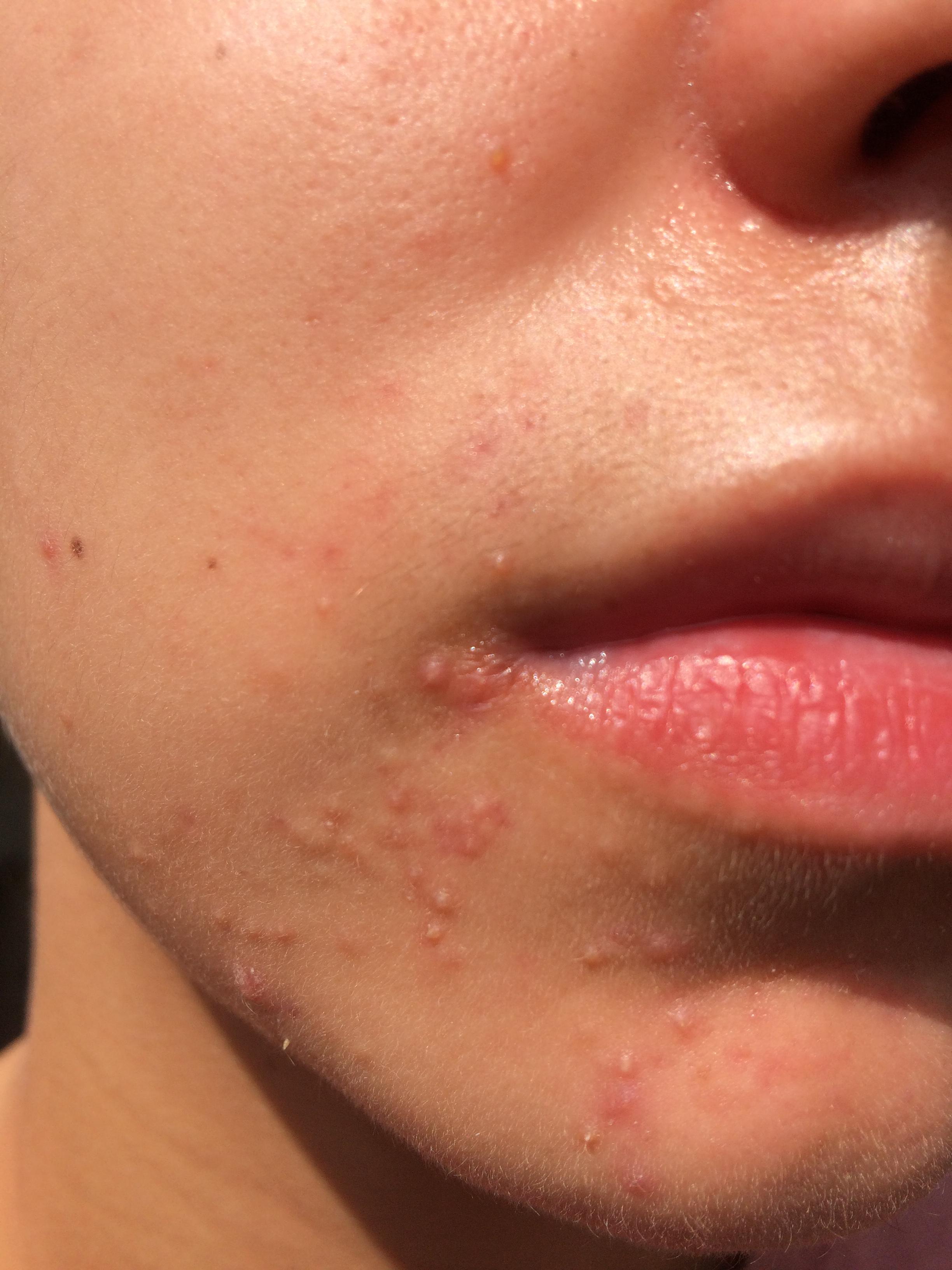 Little bumps around mouth and cheeks - General acne discussion - by